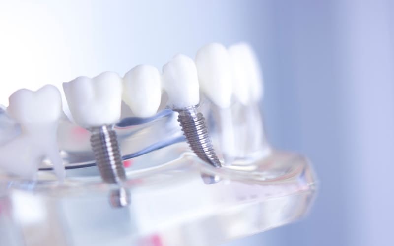 Dental Implants - Dentistry Of Kingwood, TX