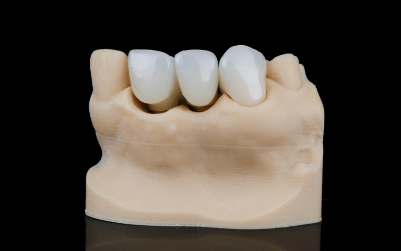 How Does A Dentist Remove A Dental Crown?