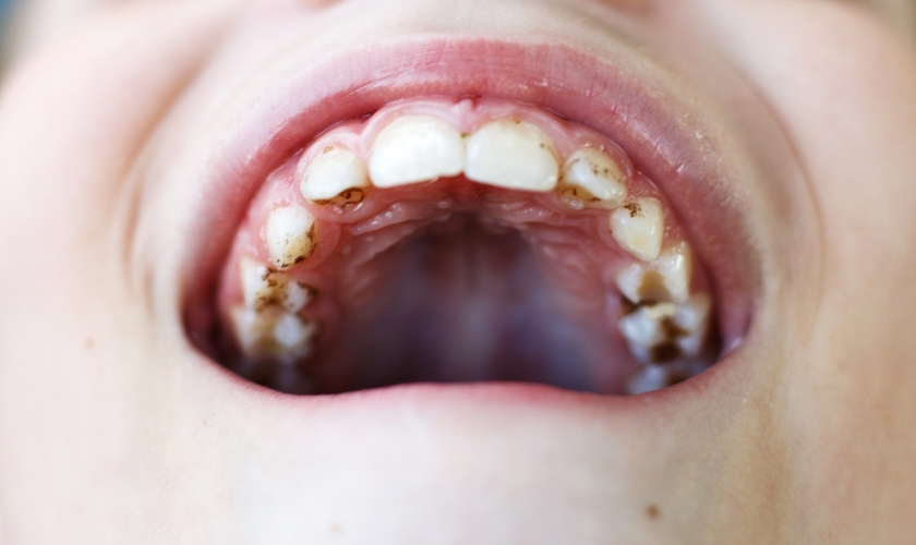 causes of black spots on teeth