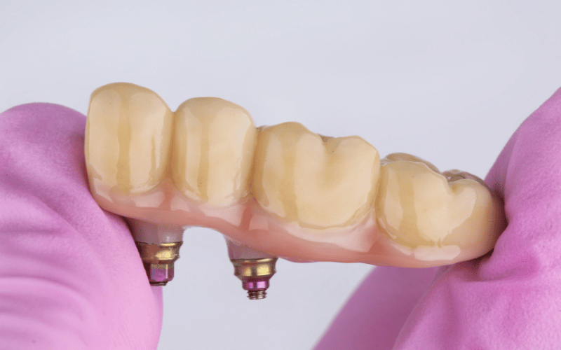 Dental bridges