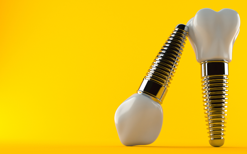 Dental Implant Restoration For Missing Teeth