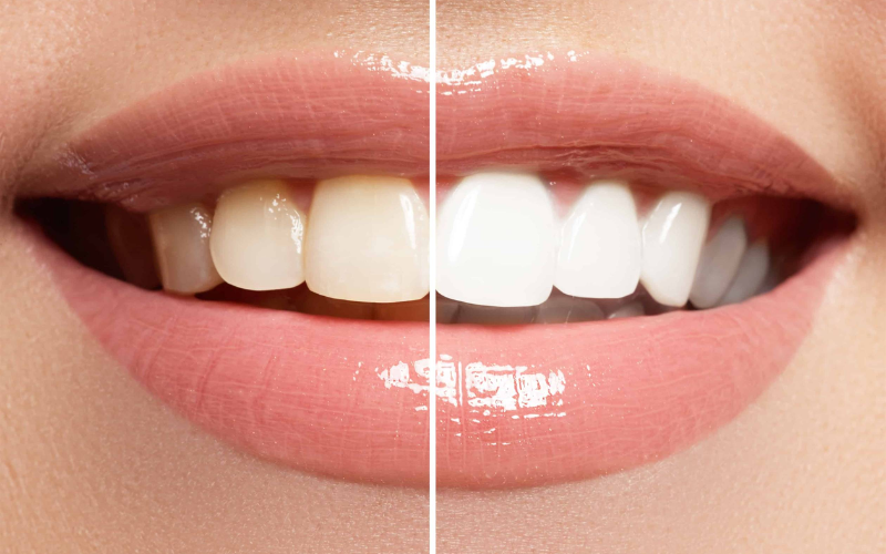 How Often Should You Be Whitening Teeth