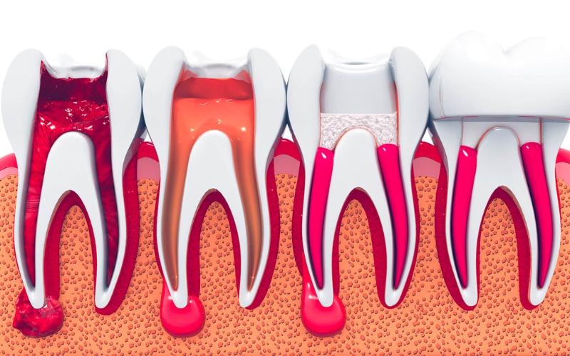 How Root Canals Save Teeth and Stop Tooth Loss
