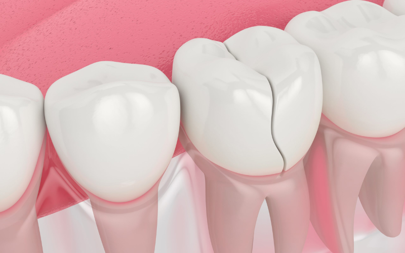 Restorative dentistry for cracked or broken teeth