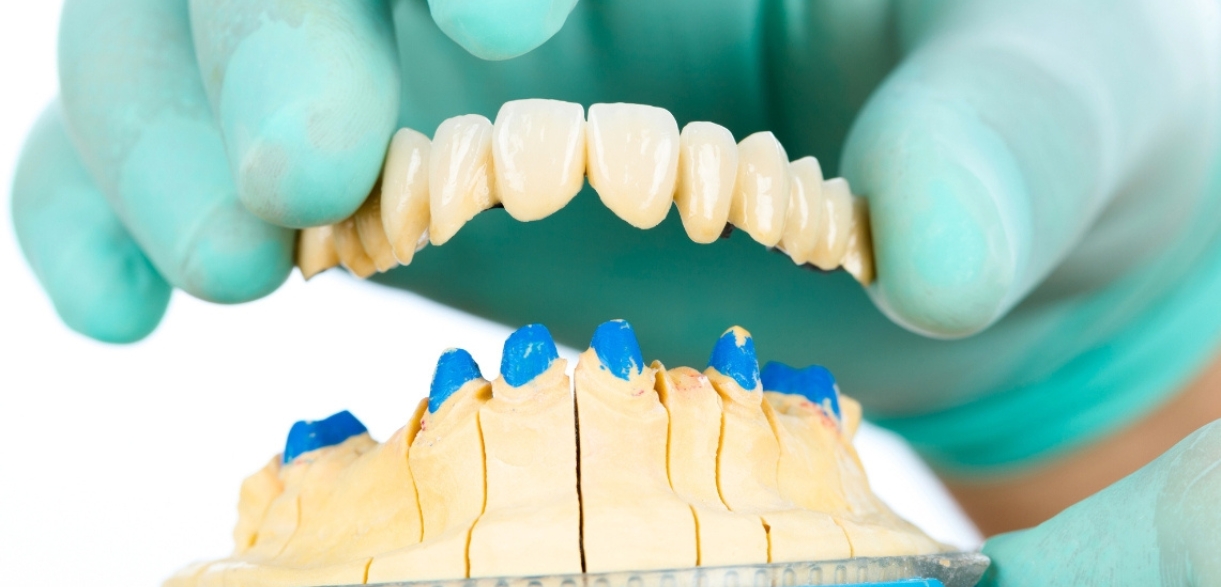 Dental Bridge After Tooth Extraction