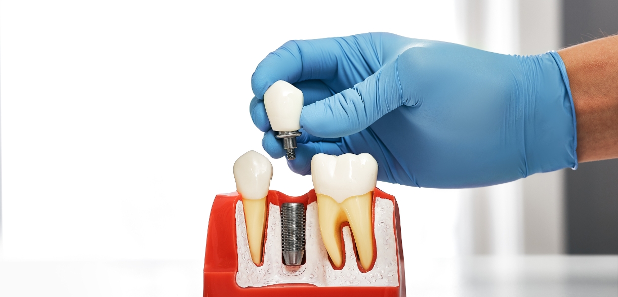 How Dental Implant Restoration Restores More Than Just Your Smile