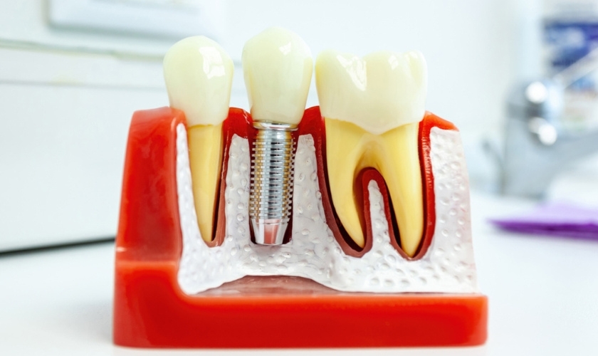 dental implants in Kingwood