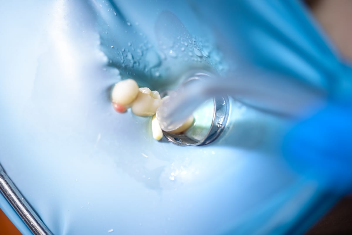Root Canal Treatment in Kingwood